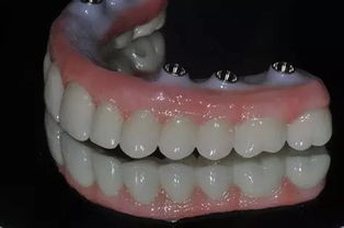 最近的研究有 全口义齿or种植,哪个患者感觉好